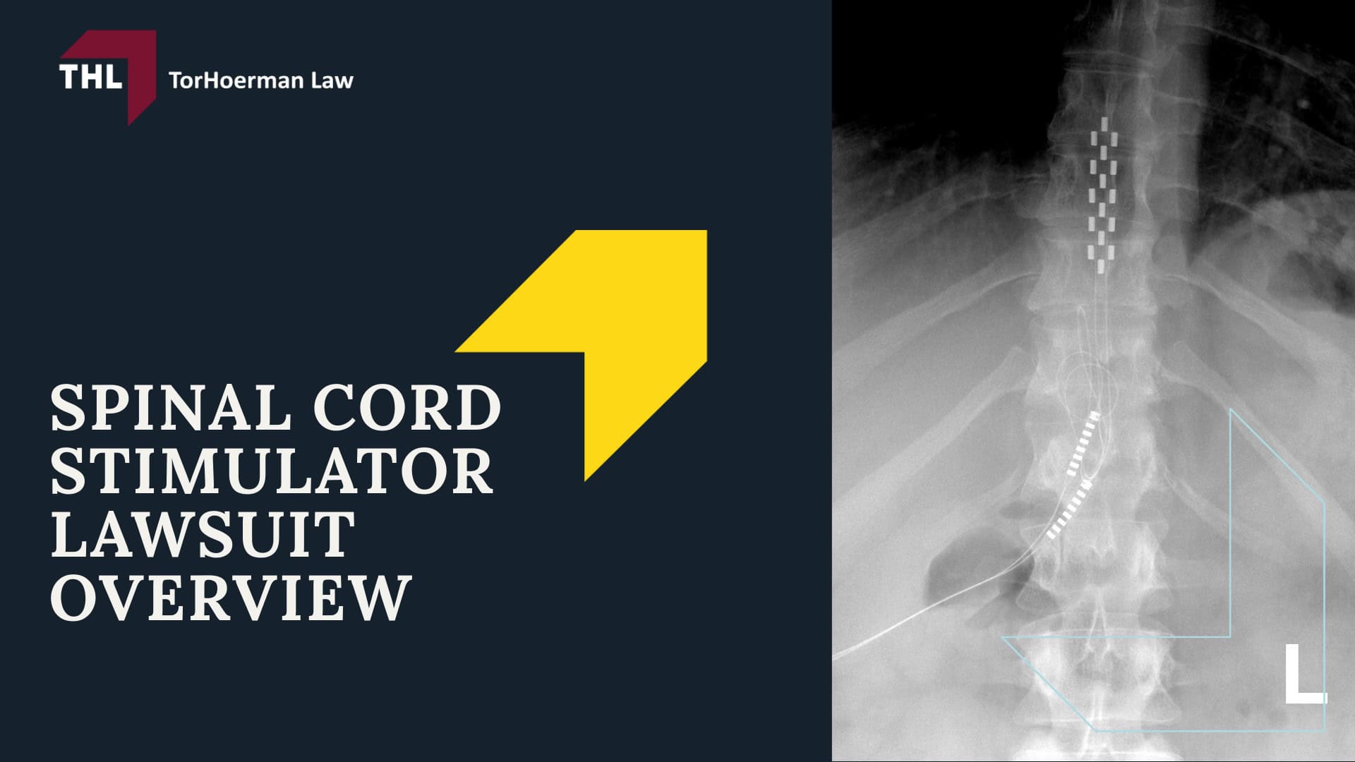 Spinal Cord Stimulator Lawsuit - Spinal Cord Stimulator Lawsuit Overview - torhoerman law