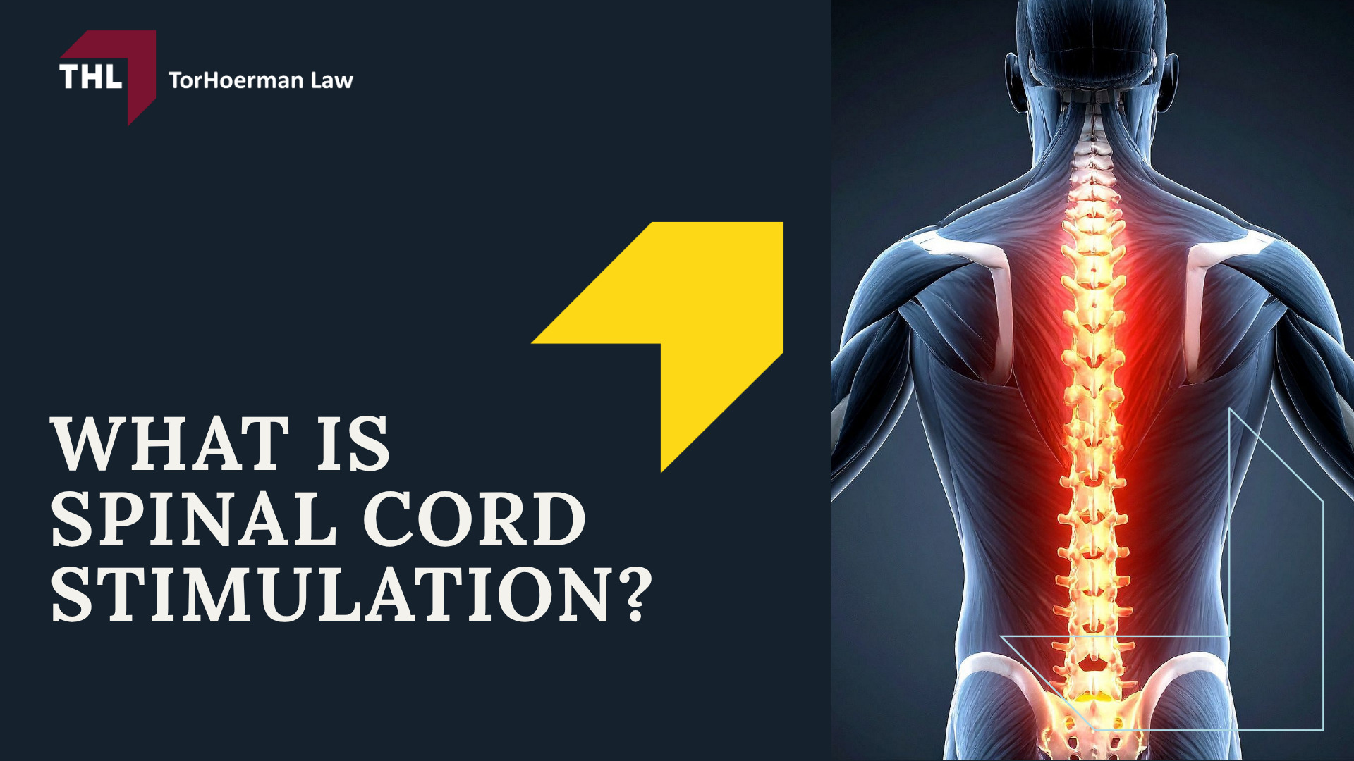 Spinal Cord Stimulator Lawsuit Overview; What Do Spinal Cord Stimulator Lawsuits Allege; Spinal Cord Stimulator Risks_ Injuries and Complications; What is Spinal Cord Stimulation