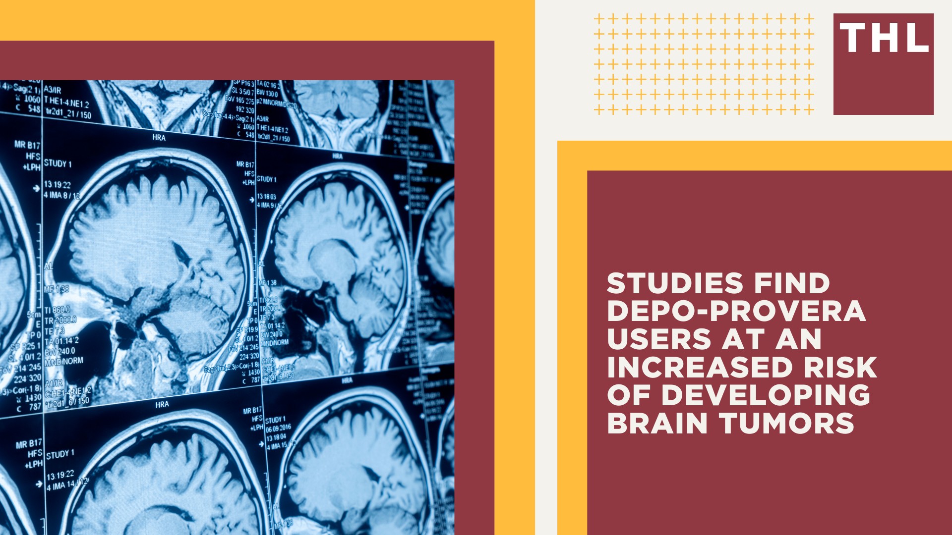 An Overview of the New Depo-Provera Lawsuit; Projections for Depo-Provera Settlements; Why is there a New Depo-Provera Lawsuit Filed; Studies Find Depo-Provera Users at an Increased Risk of Developing Brain Tumors