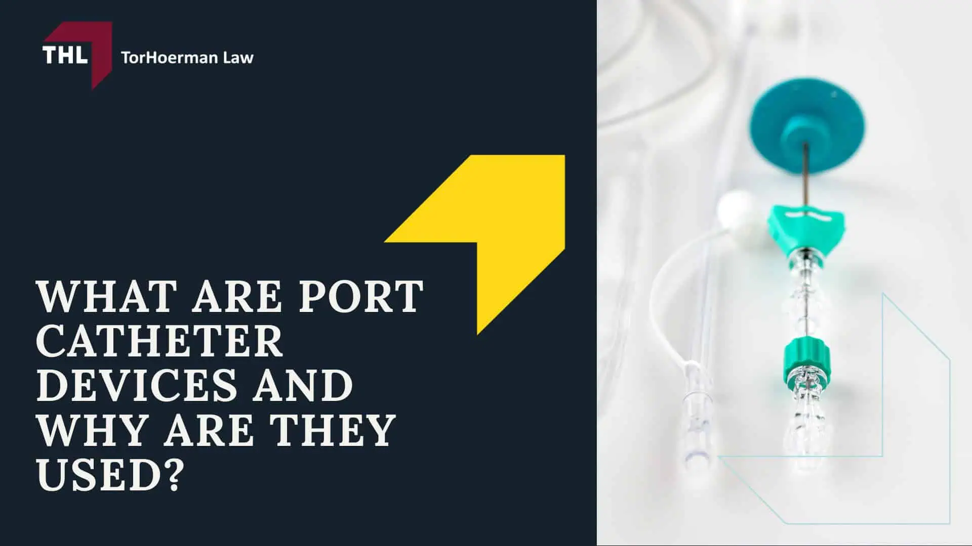 Projected AngioDynamics Port Catheter Lawsuit Settlement Amounts; AngioDynamics Port Catheter Linked to Severe Complications; What are Port Catheter Devices and Why are they Used?