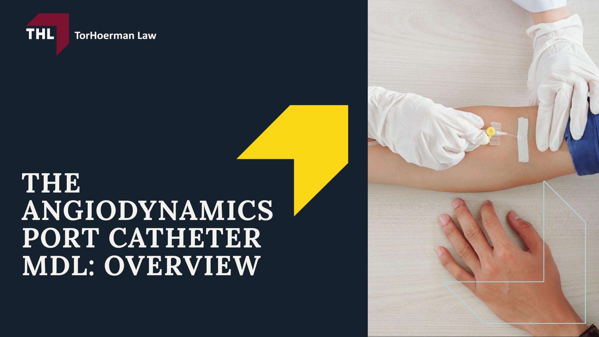 AngioDynamics Smart Port Lawsuit - What is the AngioDynamics Smart Port Lawsuit - torhoerman law; AngioDynamics Smart Port Lawsuit - The AngioDynamics Port Catheter MDL Overview - torhoerman law