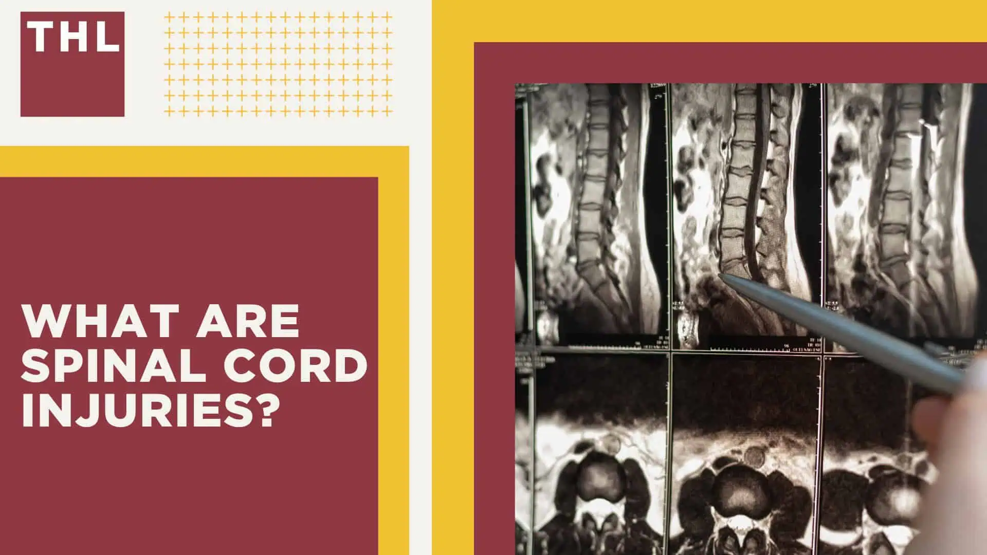 Meet Our Team of Atlanta Spinal Cord Injury Lawyers; Our Founder_ Tor Hoerman; What Are Spinal Cord Injuries