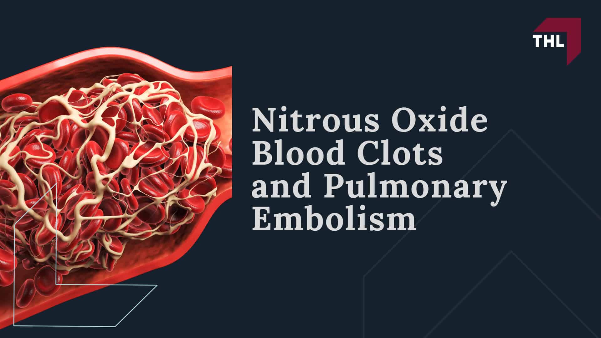 Health Risks and Dangers Related to Nitrous Oxide Use; How Nitrous Oxide Causes Neurological Damage; Nitrous Oxide Blood Clots and Pulmonary Embolism