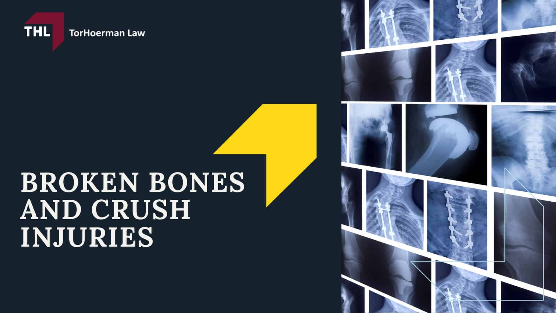 Common Truck Accident Injuries - Common Truck Accident Injuries - torhoerman law; Common Truck Accident Injuries - Common Truck Accident Scenarios That Cause Serious Injury - torhoerman law; Common Truck Accident Injuries - Traumatic Brain Injuries (TBI) Caused by Truck Accidents - torhoerman law; Common Truck Accident Injuries - Spinal Cord Injuries and Paralysis - torhoerman law; Common Truck Accident Injuries - Neck Injuries and Whiplash - torhoerman law; Common Truck Accident Injuries - Broken Bones and Crush Injuries - torhoerman law