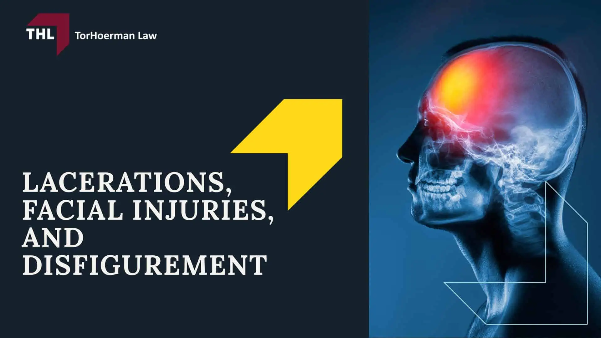 Common Truck Accident Injuries - Internal Injuries and Organ Damage - torhoerman law; Common Truck Accident Injuries - Back Injuries and Chronic Pain Conditions - torhoerman law; Common Truck Accident Injuries - Burns, Fire Injuries, and Chemical Exposure - torhoerman law; Common Truck Accident Injuries - Lacerations, Facial Injuries, and Disfigurement - torhoerman law