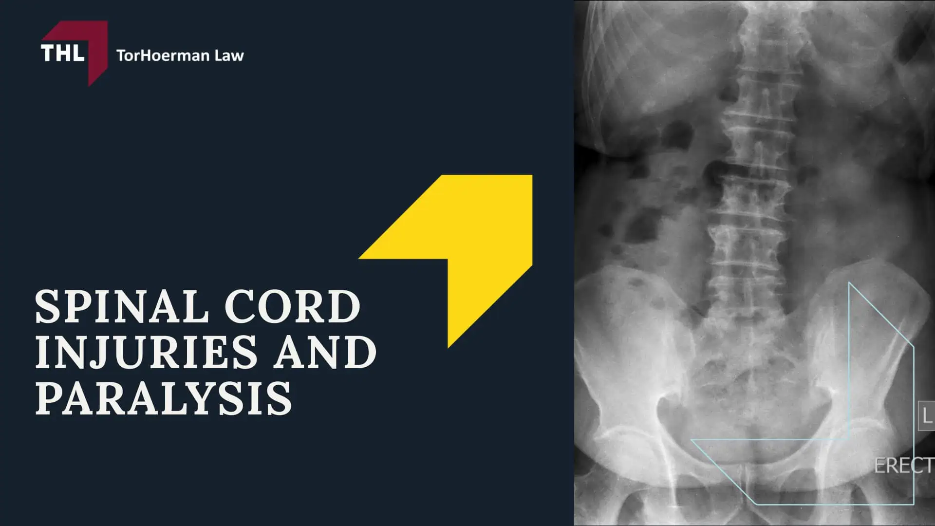 Common Truck Accident Injuries - Common Truck Accident Injuries - torhoerman law; Common Truck Accident Injuries - Common Truck Accident Scenarios That Cause Serious Injury - torhoerman law; Common Truck Accident Injuries - Traumatic Brain Injuries (TBI) Caused by Truck Accidents - torhoerman law; Common Truck Accident Injuries - Spinal Cord Injuries and Paralysis - torhoerman law