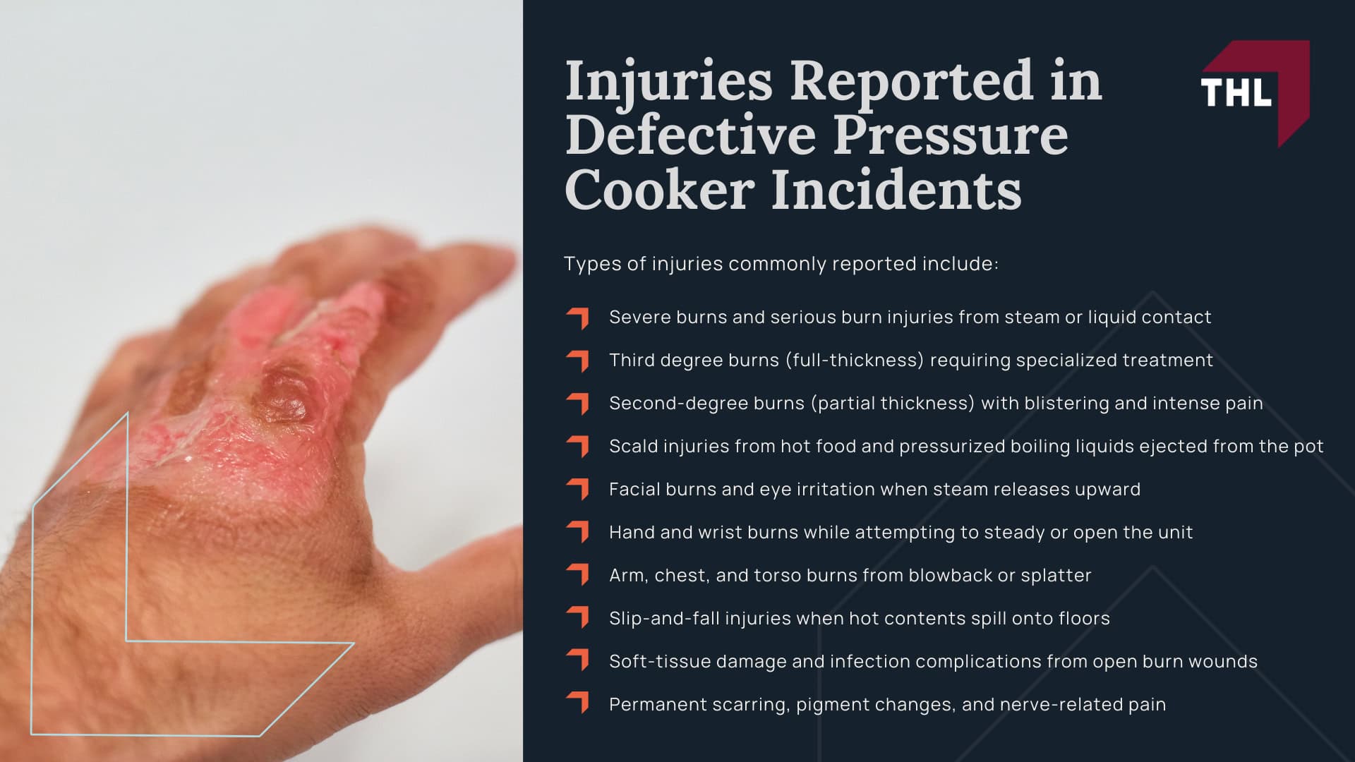 Sensio Pressure Cooker Lawsuit - Sensio Pressure Cooker Lawsuit Overview - Torhoerman law; Sensio Pressure Cooker Lawsuit - What Sensio Pressure Cookers are Recalled_ - Torhoerman law; Sensio Pressure Cooker Lawsuit - Injuries Reported in Defective Pressure Cooker Incidents - Torhoerman law