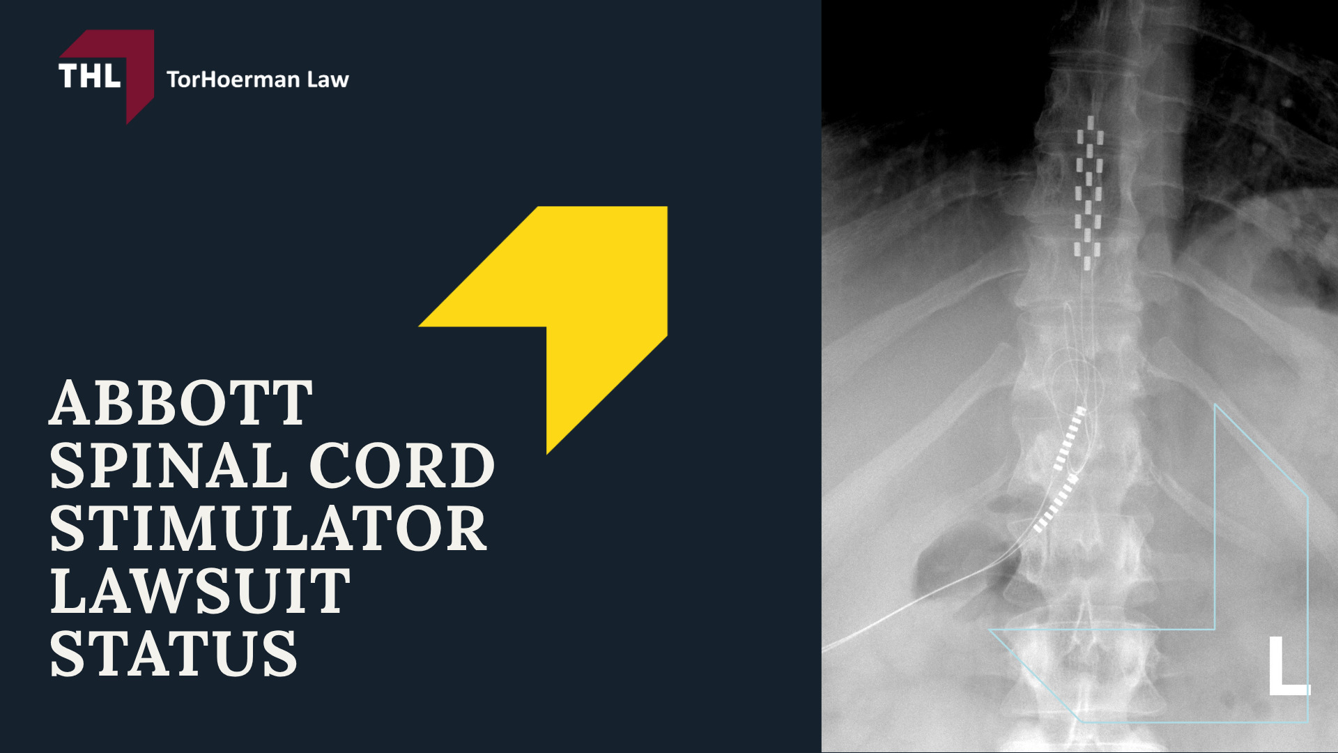 What Is the Abbott Spinal Cord Stimulator Lawsuit About; Abbott Lawsuit Investigation Overview