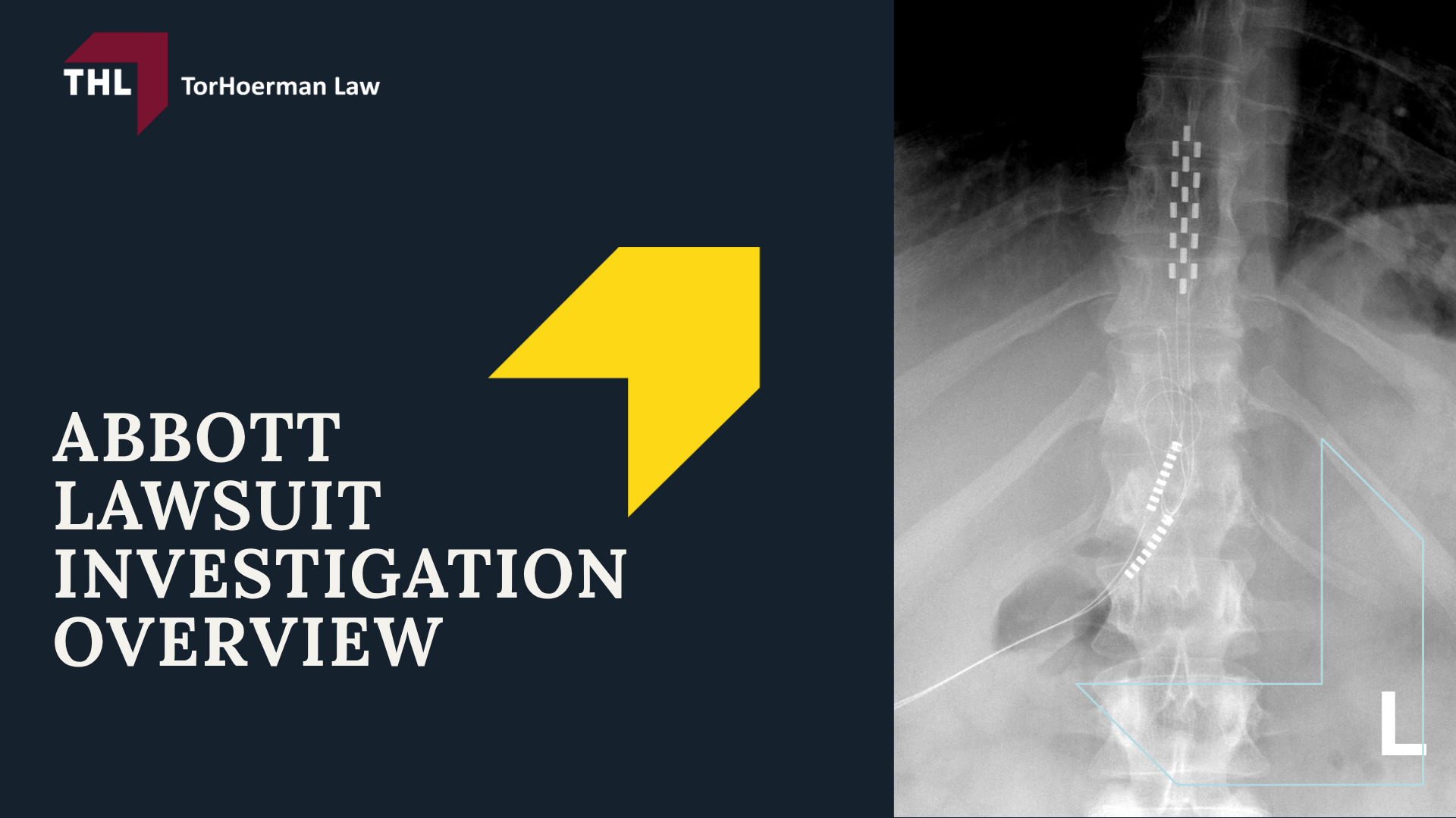 Abbott Lawsuit Investigation Overview