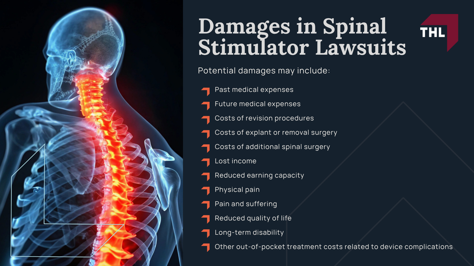 Nevro Lawsuit Investigation Overview; Injuries and Complications Linked to Spinal Stimulators; Nevro Spinal Stimulators; Do You Qualify for a Nevro Lawsuit; Gathering Evidence for a Spinal Cord Stimulator Lawsuit; Damages in Spinal Stimulator Lawsuits