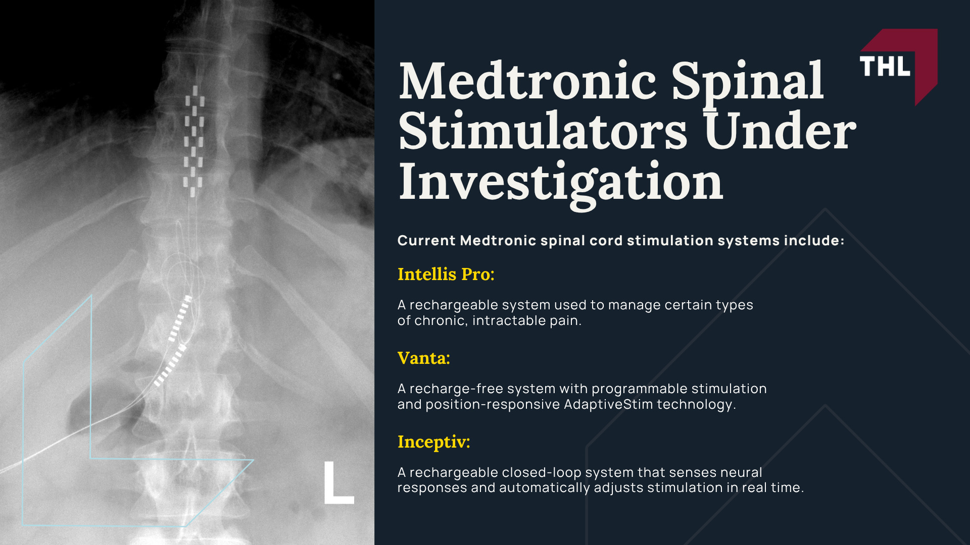 What Is the Medtronic Spinal Cord Stimulator Lawsuit About; Medtronic Spinal Stimulators Under Investigation