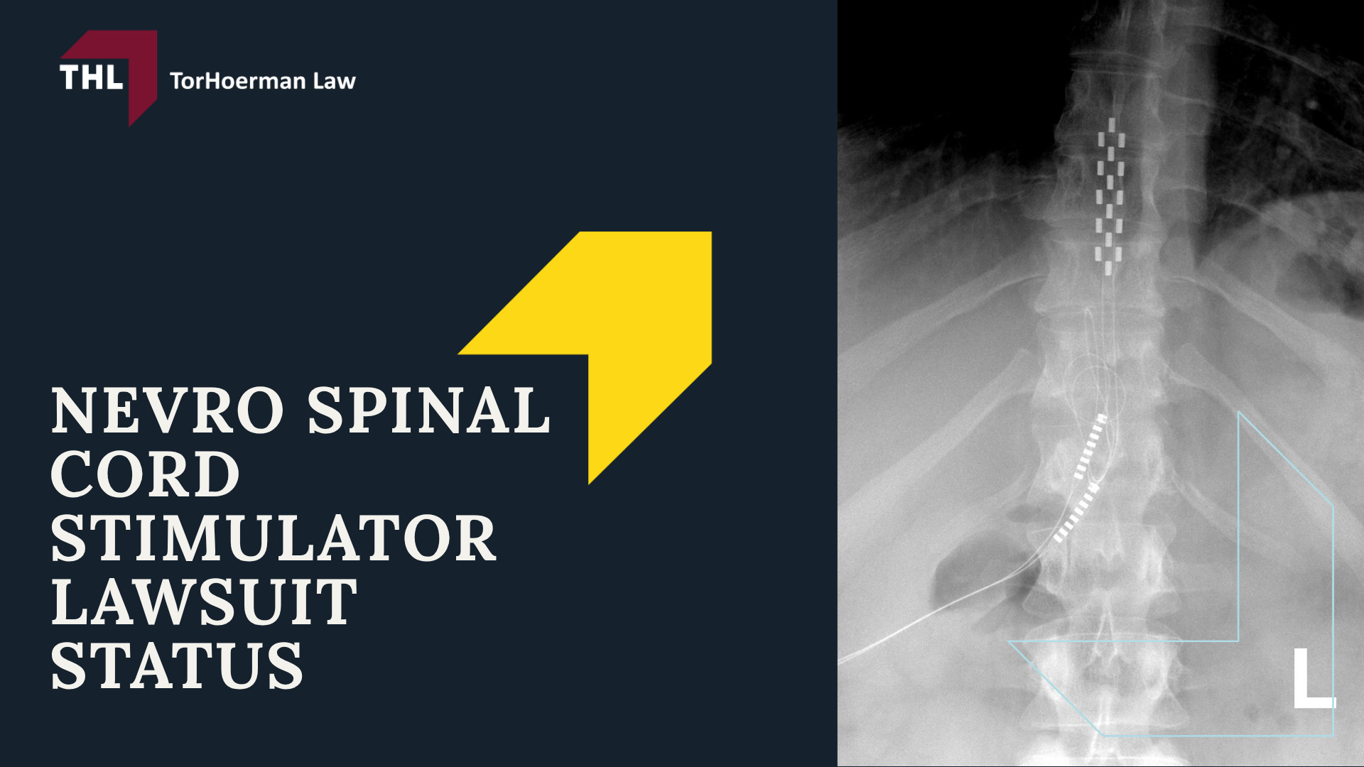 What Is the Nevro Spinal Cord Stimulator Lawsuit About; Nevro Spinal Cord Stimulator Lawsuit Status