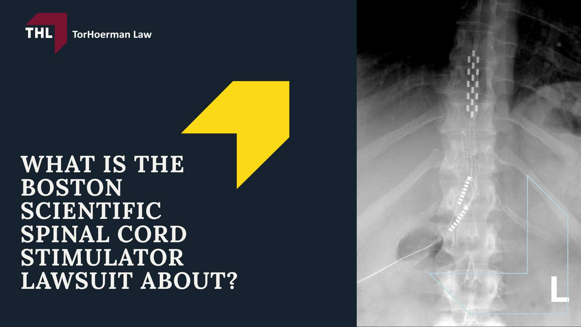 What Is the Boston Scientific Spinal Cord Stimulator Lawsuit About