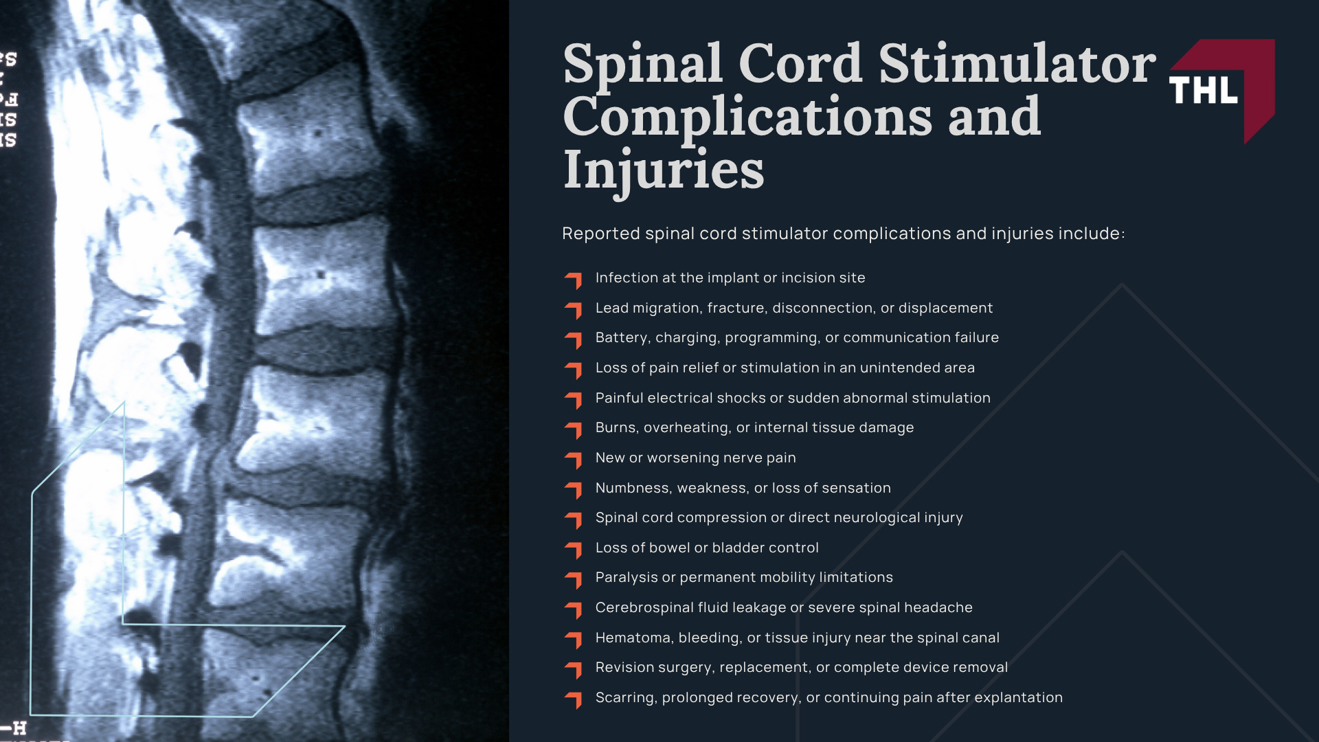 Spinal Cord Stimulator Lawsuit Overview; Spinal Cord Stimulator Lawsuit Overview (2); What Are Spinal Cord Stimulator Lawsuits Based On; Spinal Cord Stimulator Complications and Injuries
