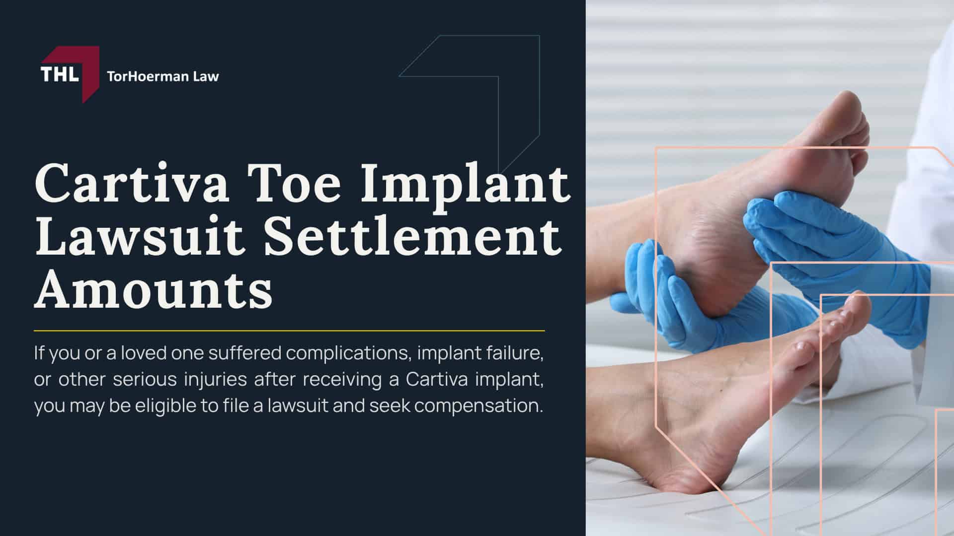 Cartiva Toe Implant Lawsuit Settlement Amounts; Cartiva Toe Implant Lawsuit Settlement Amounts_ Estimates & Projections; Factors That May Affect Cartiva Settlement Amounts; Cartiva Implant Lawsuit Overview; Reported Failure Rates and Medical Evidence; MDL No. 3172 and Ongoing Litigation; Who May Qualify for a Cartiva Implant Lawsuit; TorHoerman Law_ Accepting Cases for the Cartiva Toe Implant Lawsuit