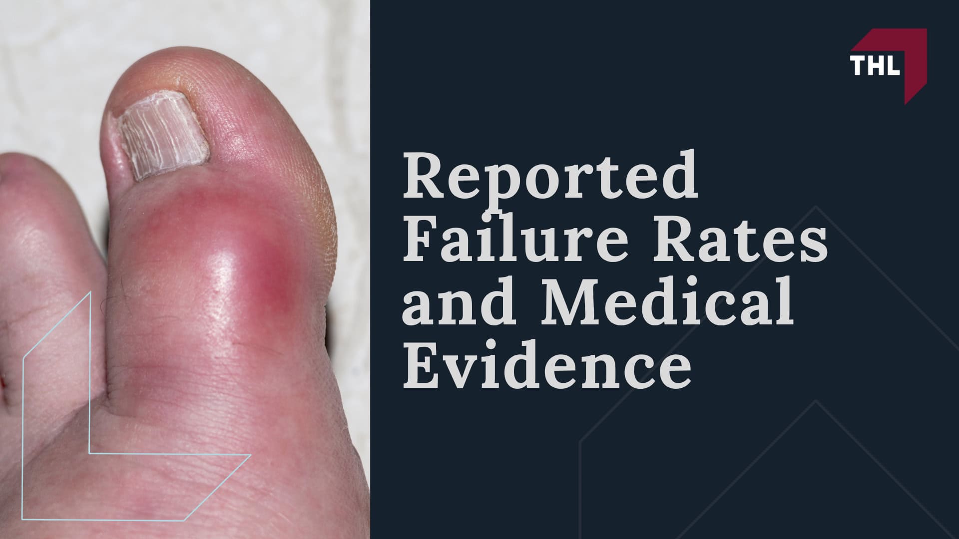 Cartiva Toe Implant Lawsuit Settlement Amounts_ Estimates & Projections; Factors That May Affect Cartiva Settlement Amounts; Cartiva Implant Lawsuit Overview; Reported Failure Rates and Medical Evidence