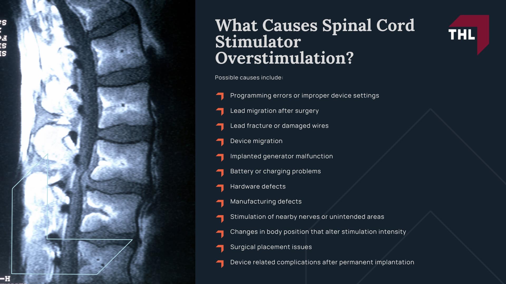 What Is Spinal Cord Stimulator Overstimulation; Common Symptoms of Spinal Cord Stimulator Overstimulation; When Are Overstimulation Symptoms a Warning Sign of Bigger Problems; What Causes Spinal Cord Stimulator Overstimulation