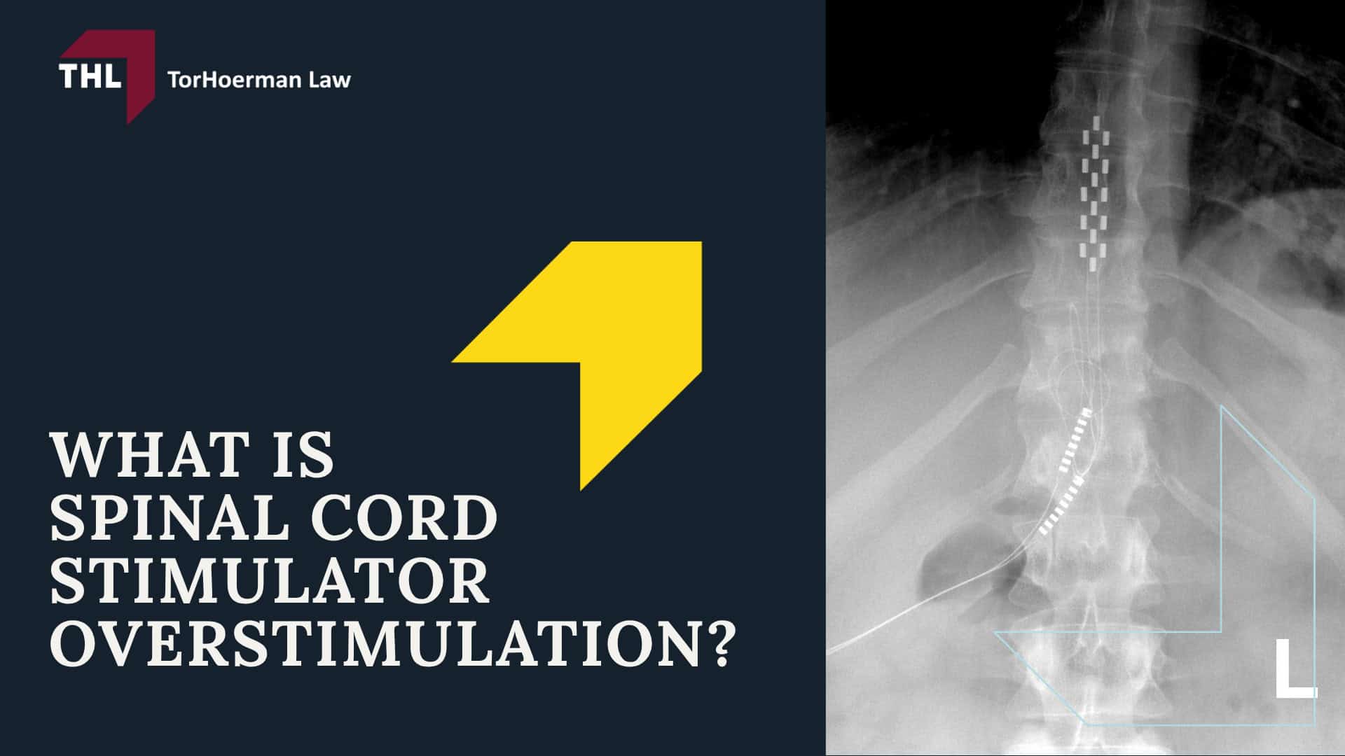 What Is Spinal Cord Stimulator Overstimulation