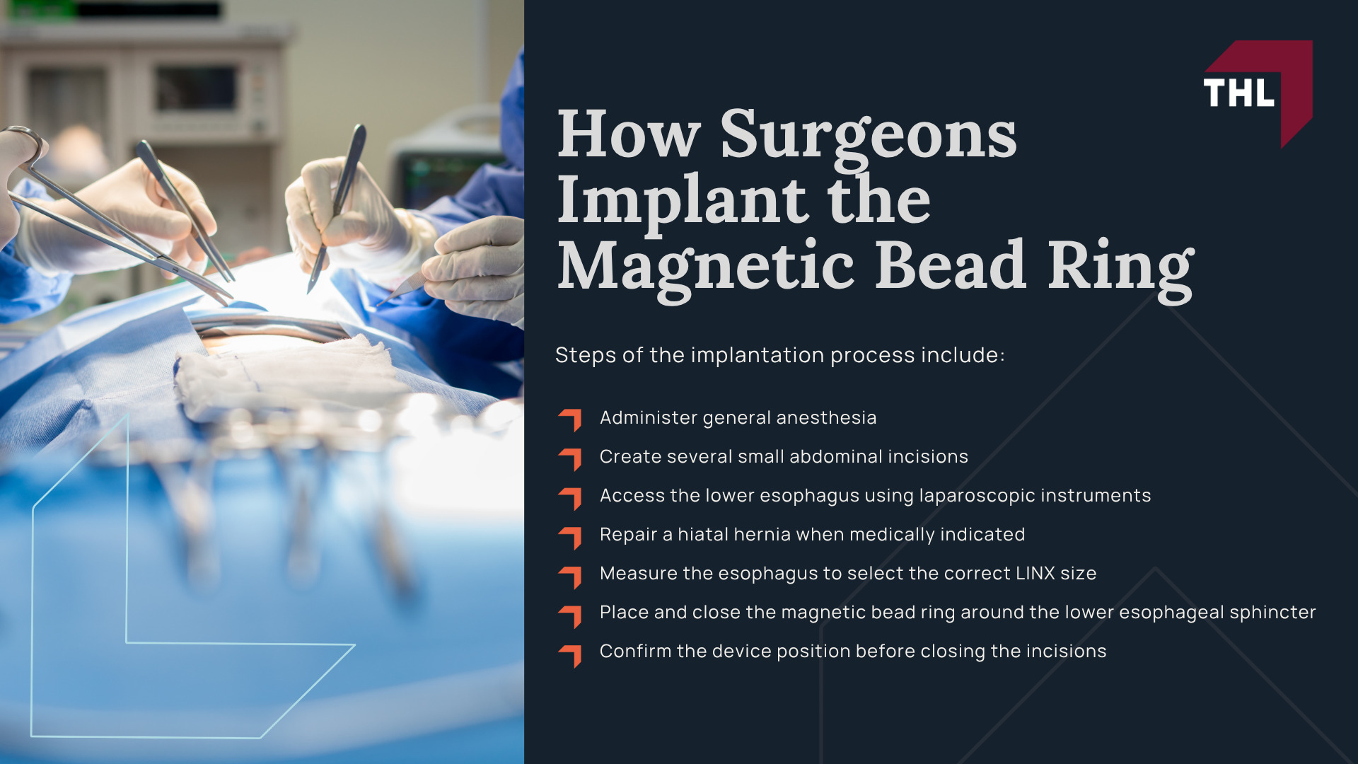 LINX Reflux Device Lawsuit Overview; LINX Device Complications and Reported Injuries; Signs That a LINX Reflux Device May Have Failed; What Is the LINX Reflux Management System; How Surgeons Implant the Magnetic Bead Ring