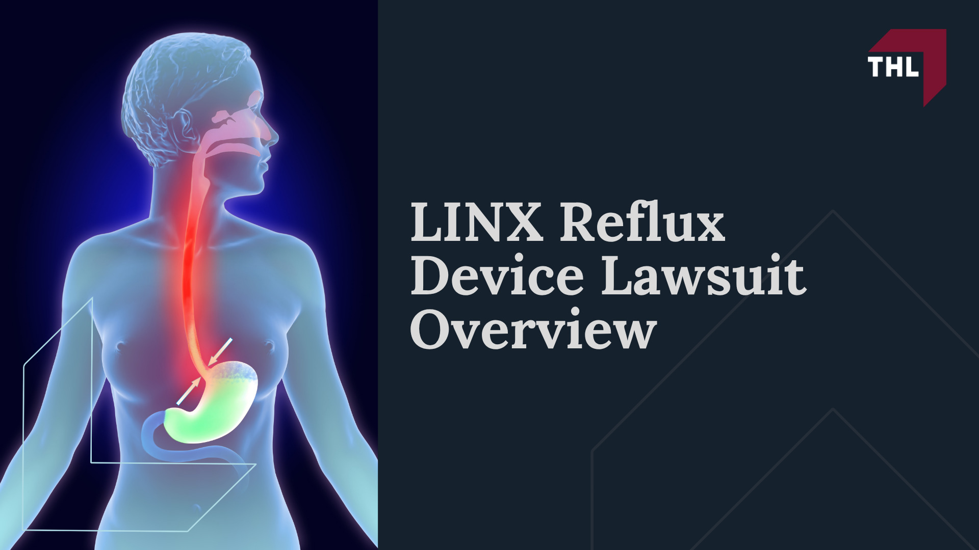 LINX Reflux Device Lawsuit Overview