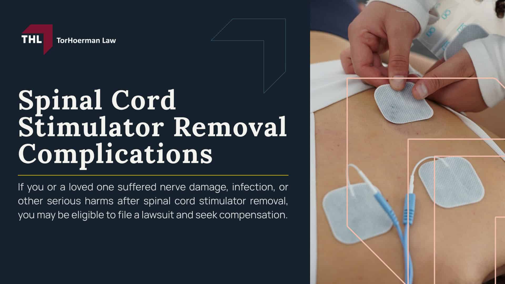 Spinal Cord Stimulator Removal Complications