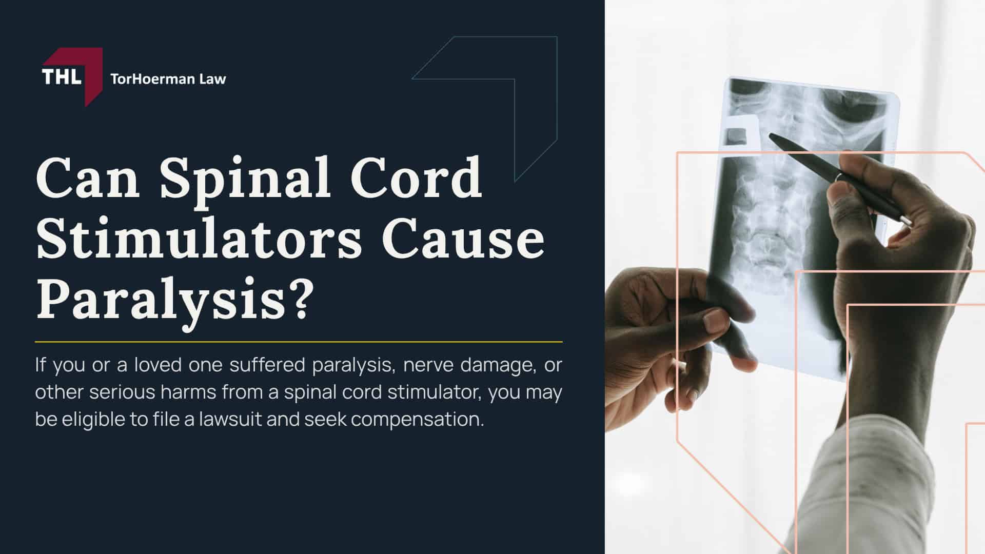 Can Spinal Cord Stimulators Cause Paralysis