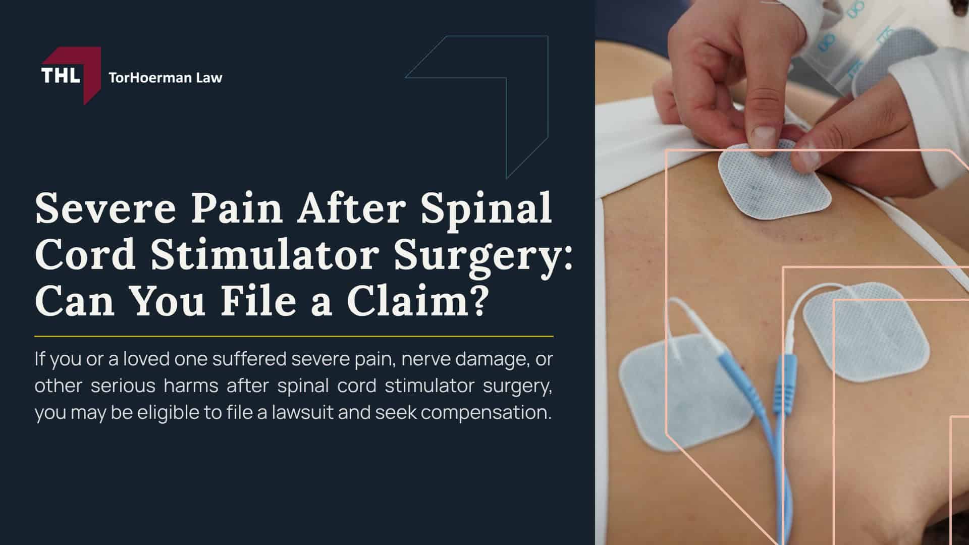 Severe Pain After Spinal Cord Stimulator Surgery Can You File a Claim